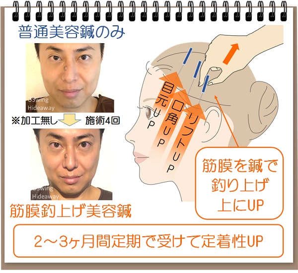 写真あり リフトアップ 細顔 話題の筋膜美容鍼 名古屋栄 3swinghideaway鍼灸院